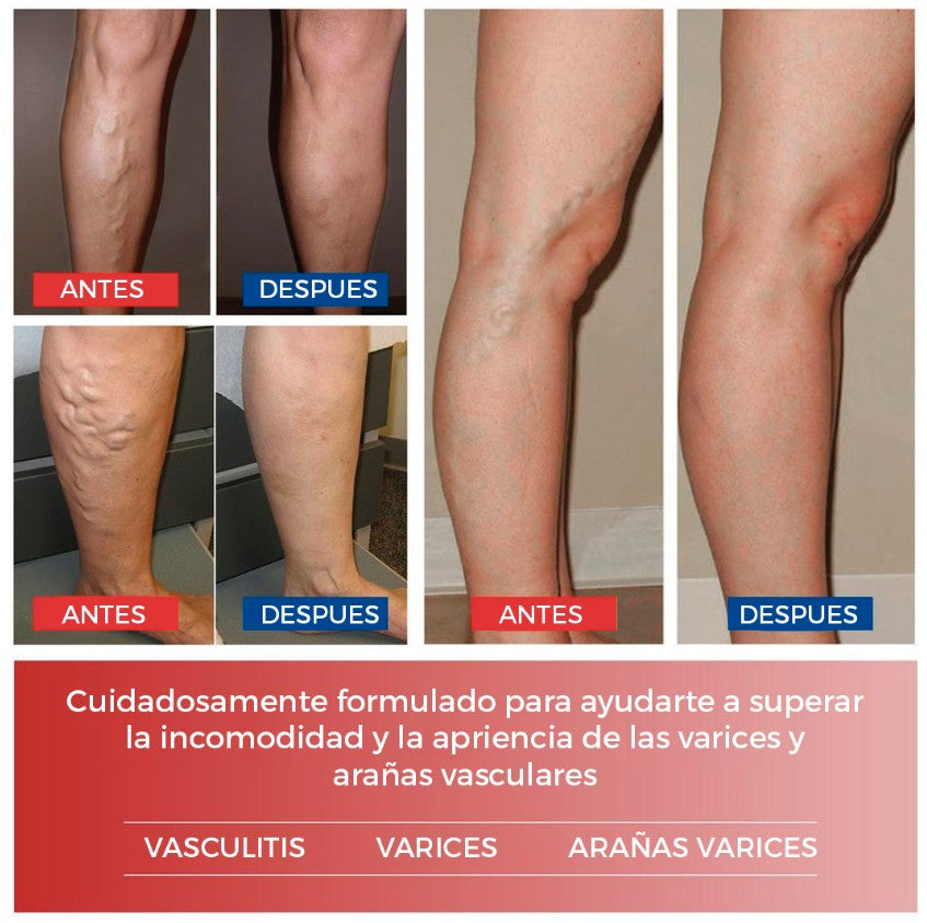 🔴PARCHES PARA VENAS VARICES